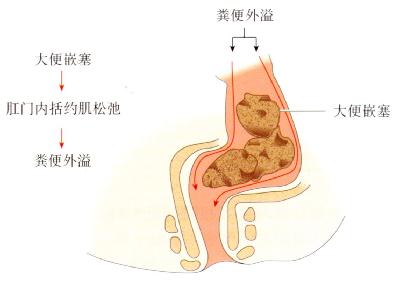 小孩肛门失禁_肛门失禁能自愈吗_肛门小孩失禁怎么治疗